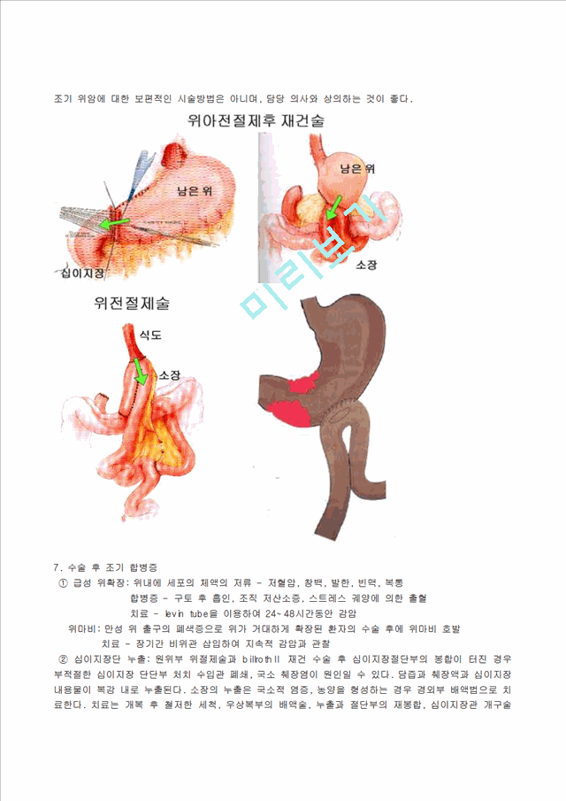 Subtatal gastrectomy   (4 )